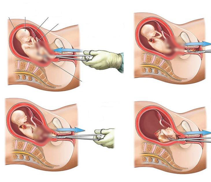 a7abort002mjpg